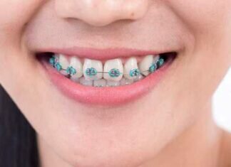 How Are the Prices for Braces Decided?
