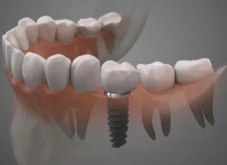 What Are The Most Natural Dental Implants? — featured image