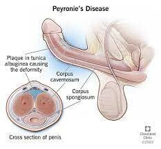 Peyronie's Disease - A Review